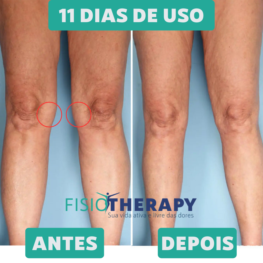 ARTICure™ - Terapia Ortopédica para Joelho